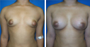 Before & After Photos